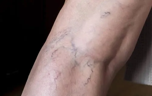 spider-veins-back-of-leg