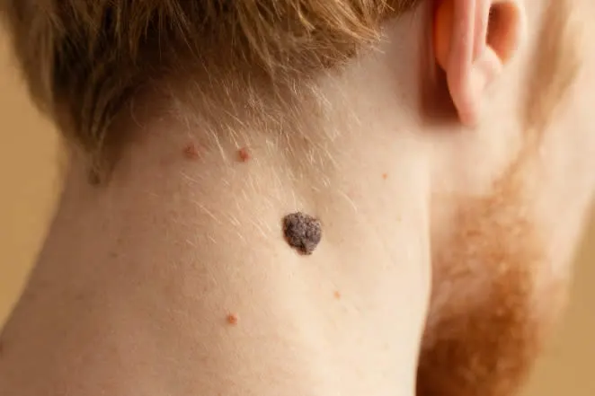 age-spots close-up-young-man-with-mole-neck